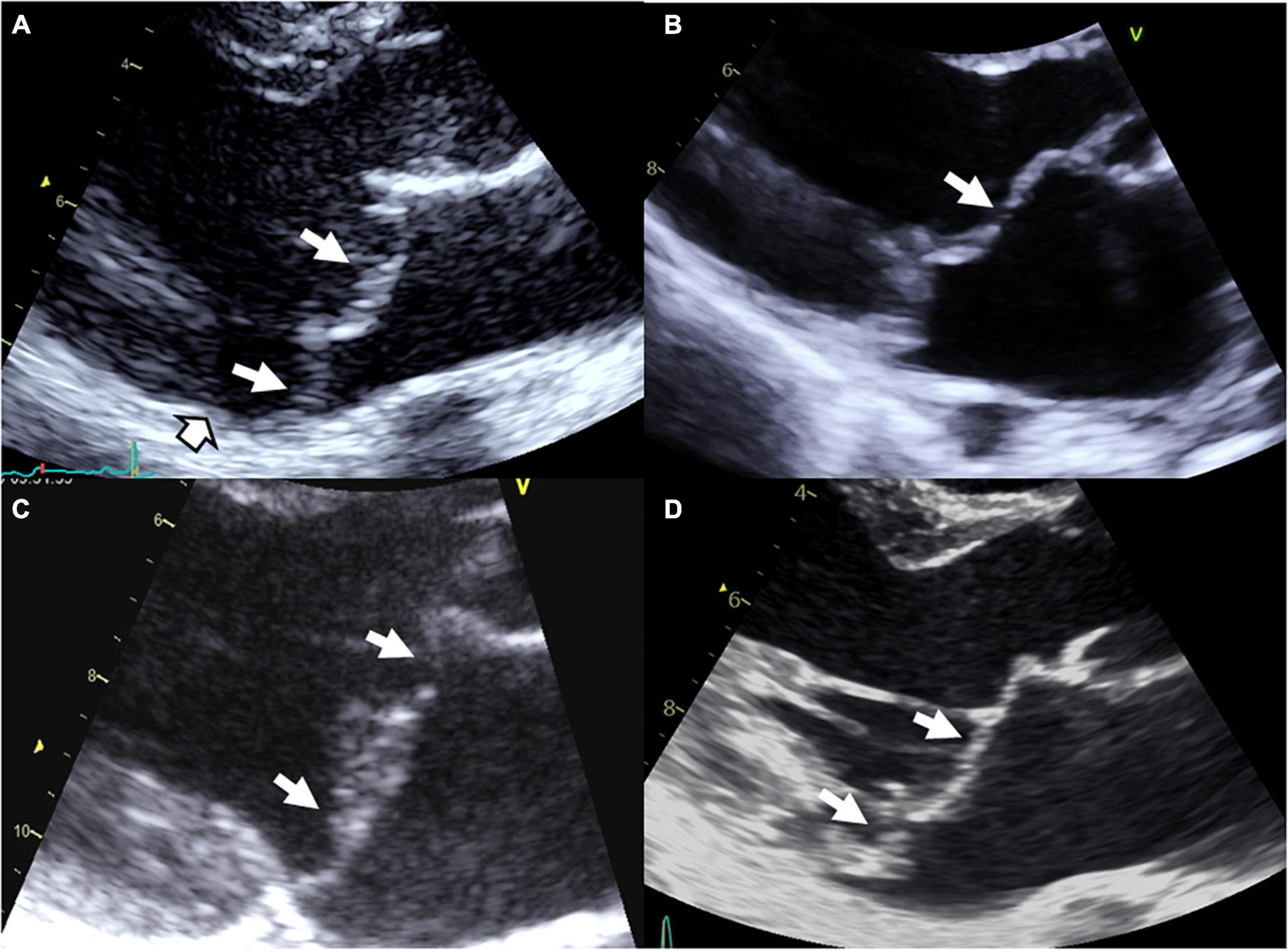 Genetics and pathophysiology of mitral valve prolapse